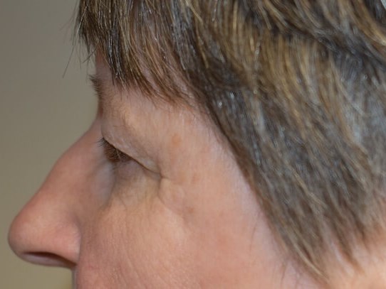 Side View Before