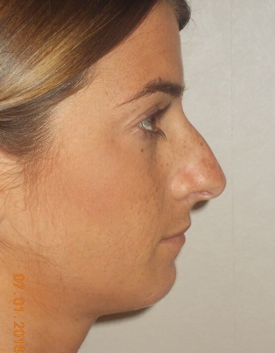 Side View Before