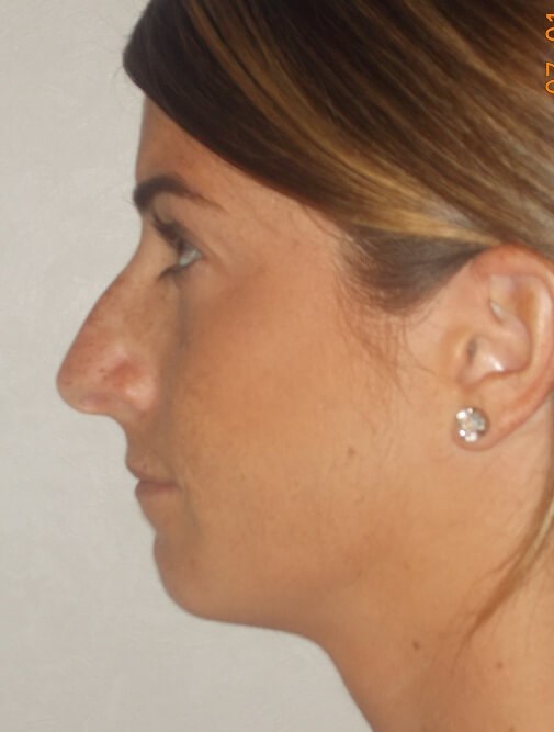 Side View Before