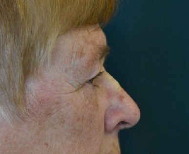 Side View Before