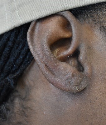 Right Earlobe Repair After