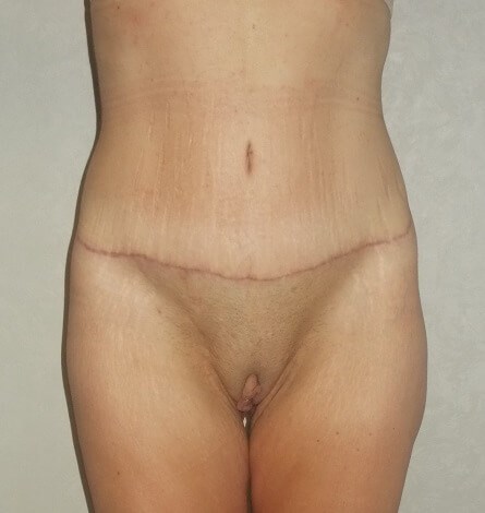 Front View After