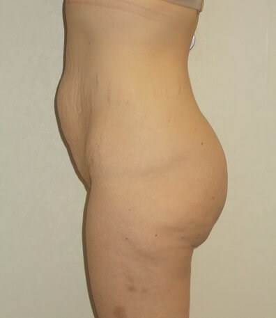 Side View Before