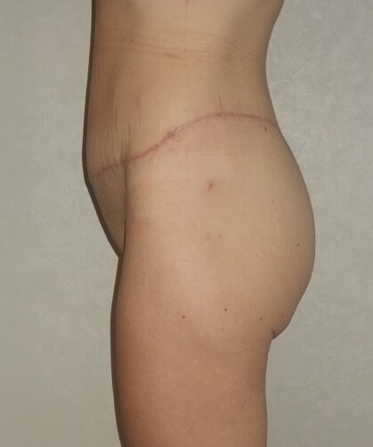 Side View After