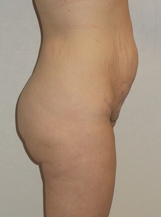 Side View Before