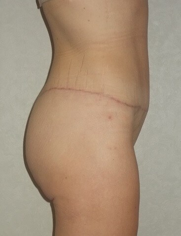 Side View After