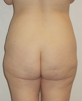 Back View Before