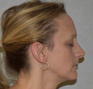 Side View Before