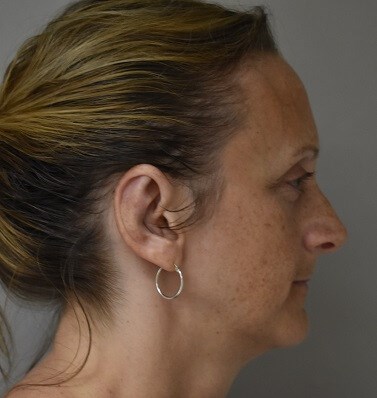 Side View After