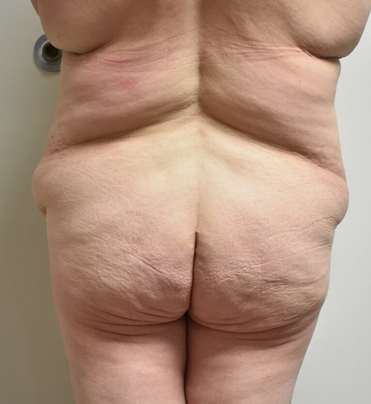 Back View Before