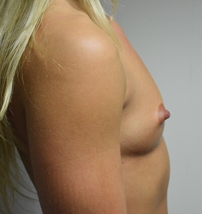 Side View Before