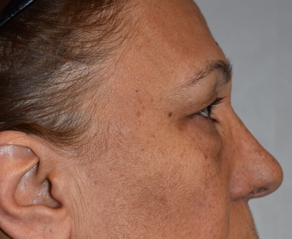 Side View Before