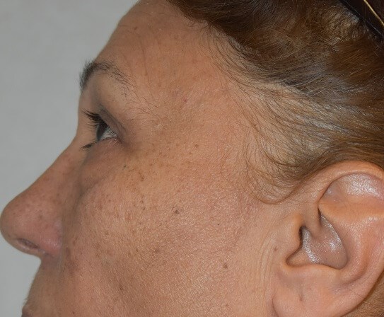 Side View Before
