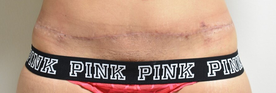 Front View After