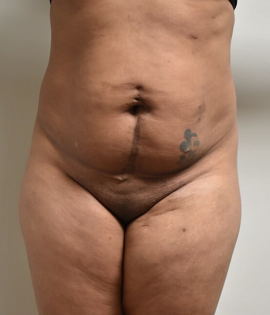 Tummy Tuck Before