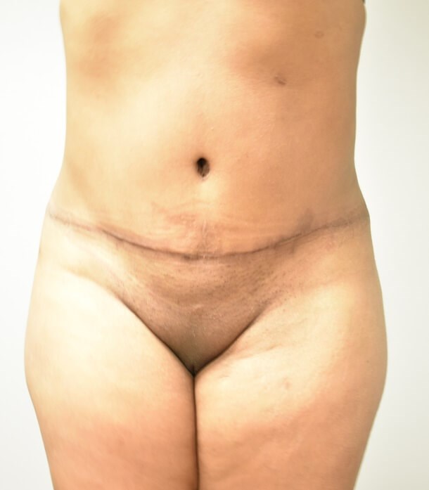 Tummy Tuck After