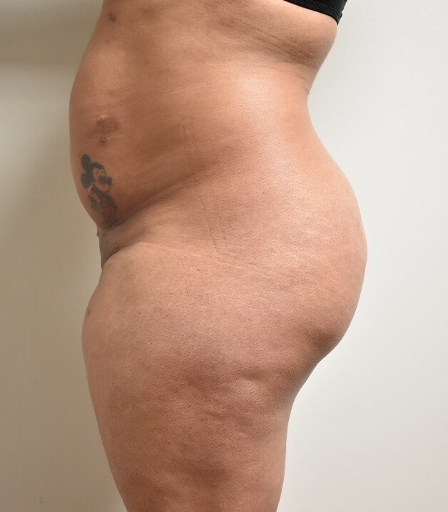 Side View Before