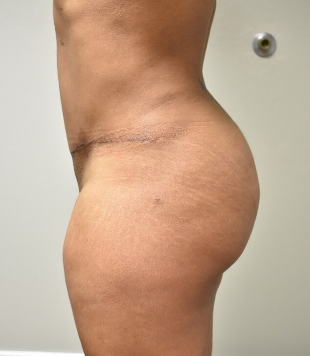 Side View After