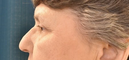 Side View After
