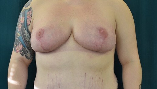 Front View After