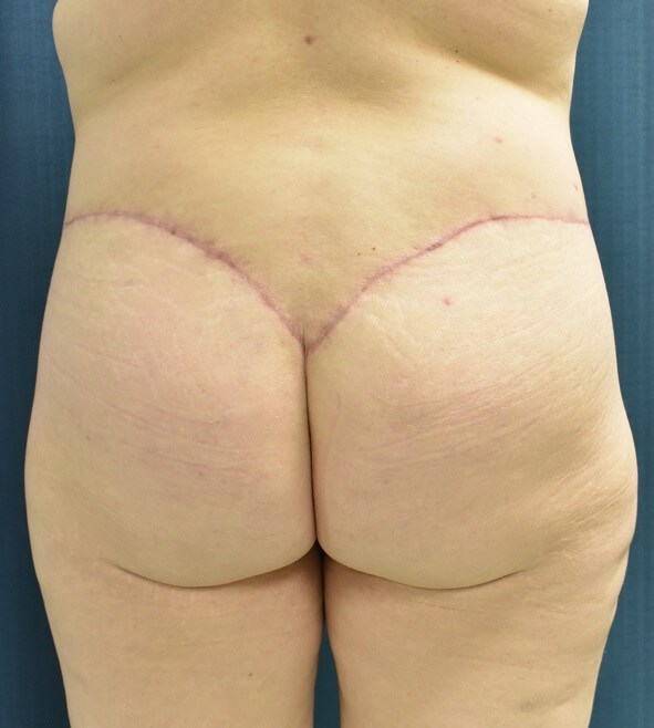 Back View After