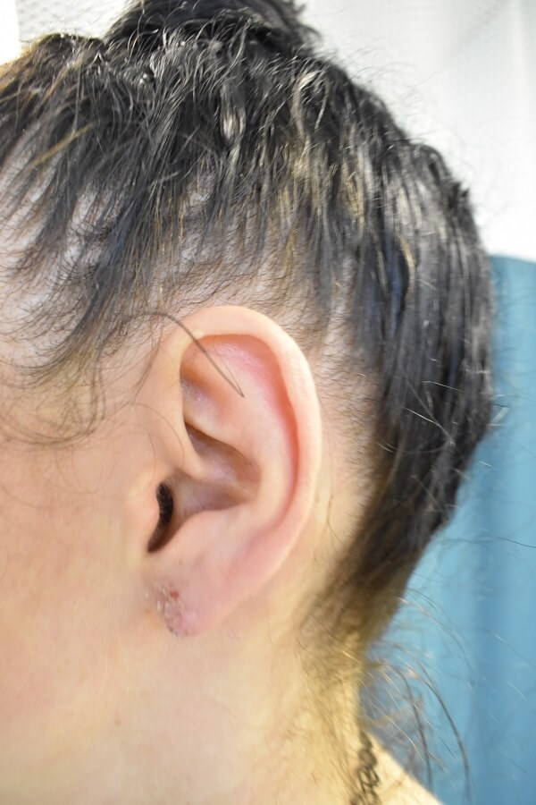 Left Side After