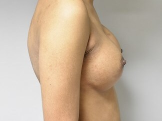 Side View After