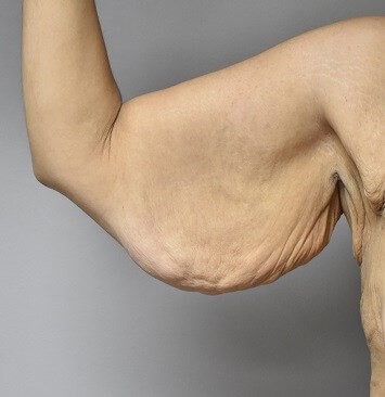 Post Gastric Bypass Before