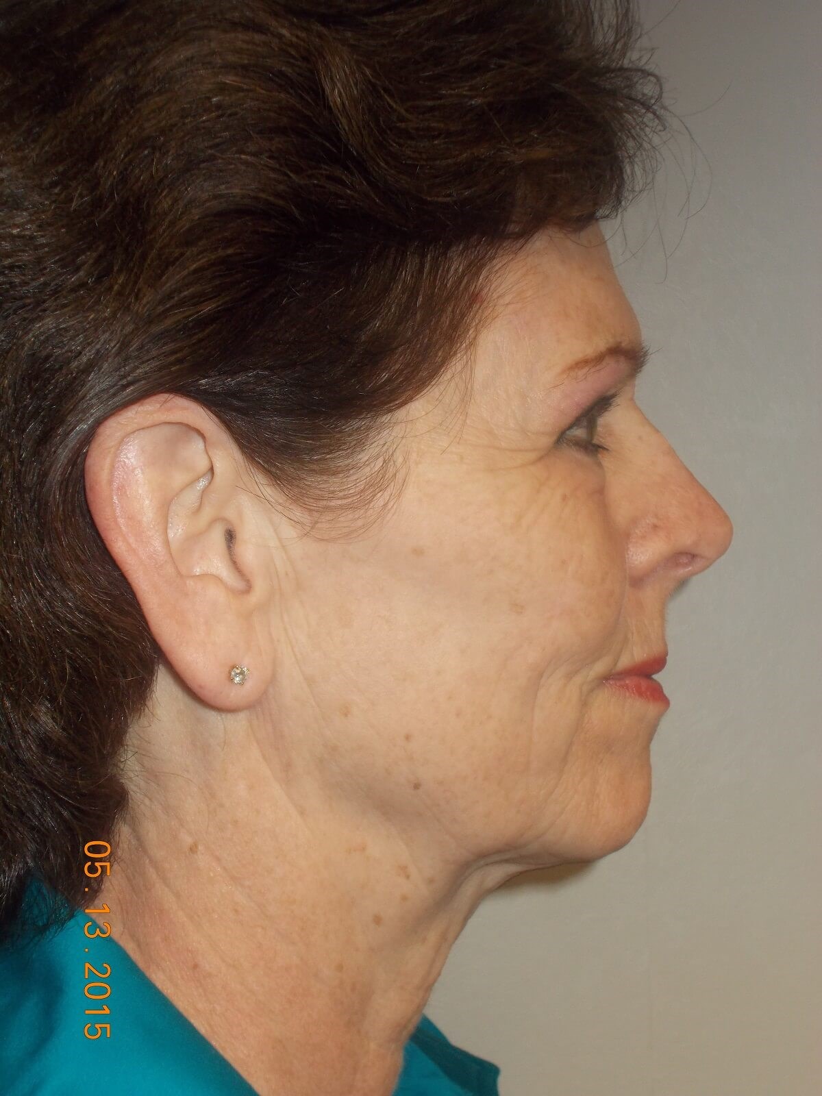 Side View Before