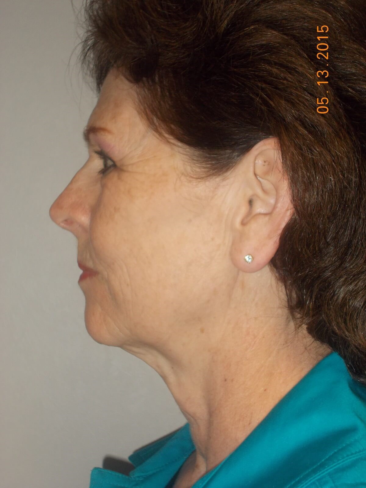 Side View Before
