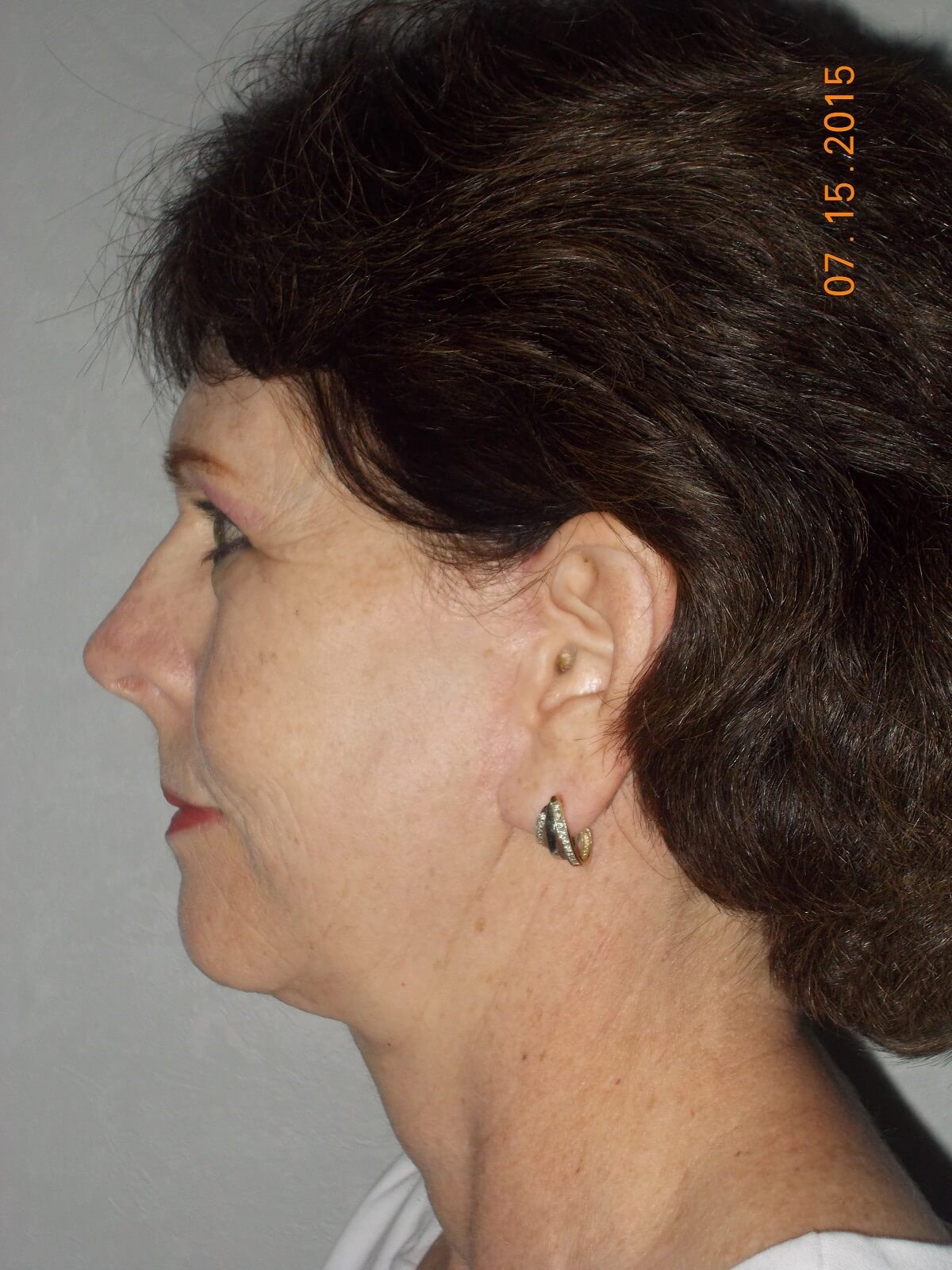 Side View After