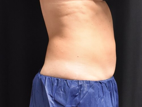 Side View After