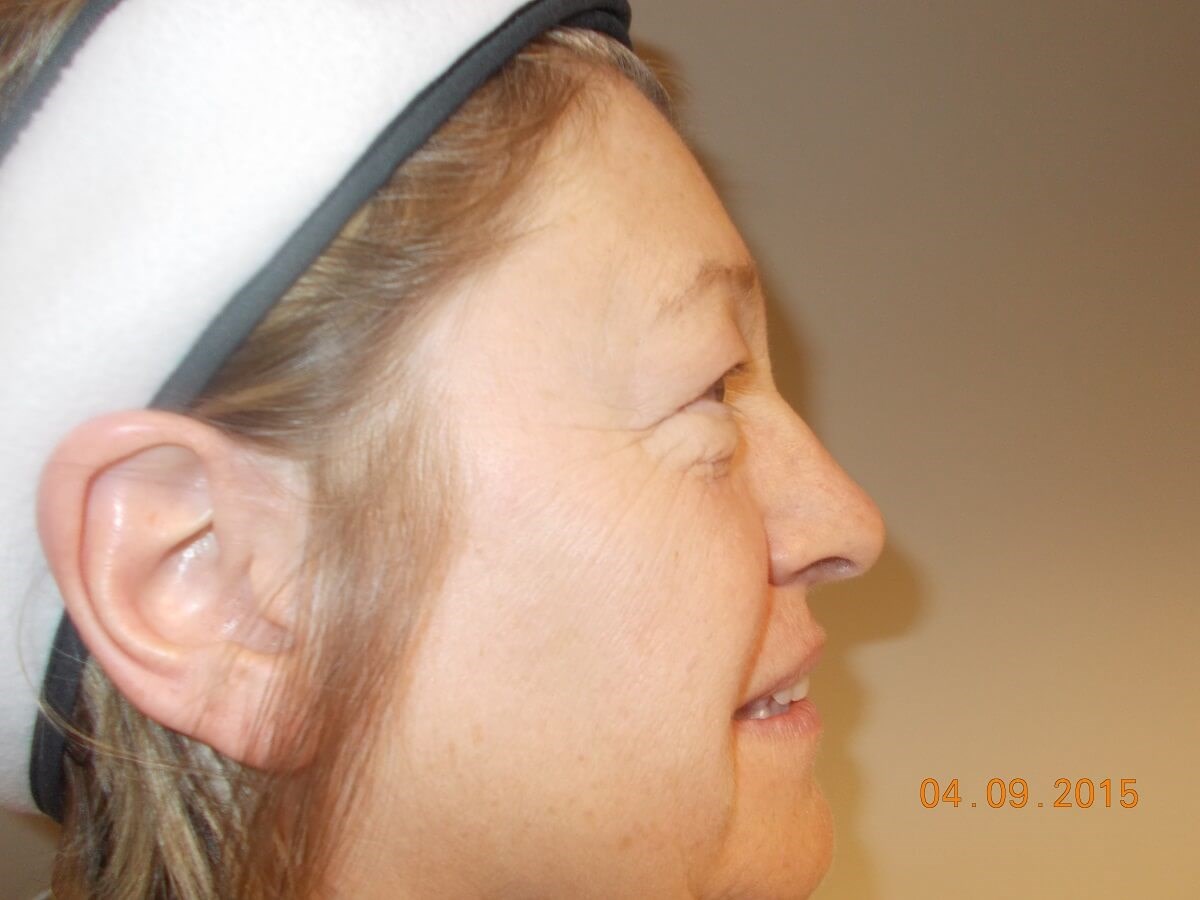Side View Before