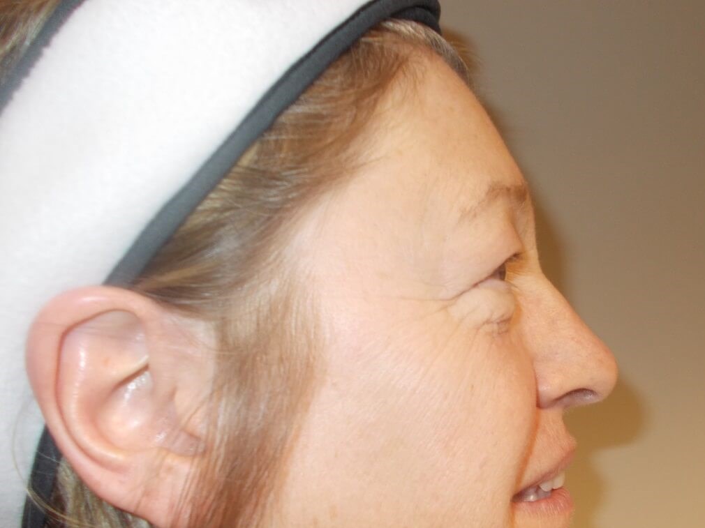 Side View Before