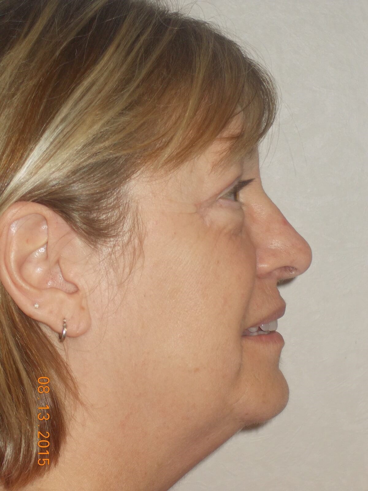 Side View After