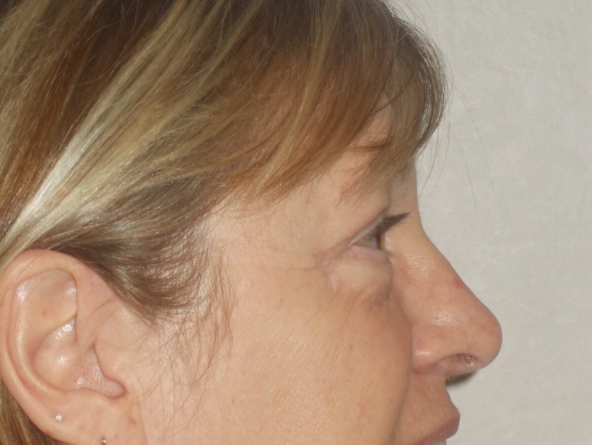 Side View After
