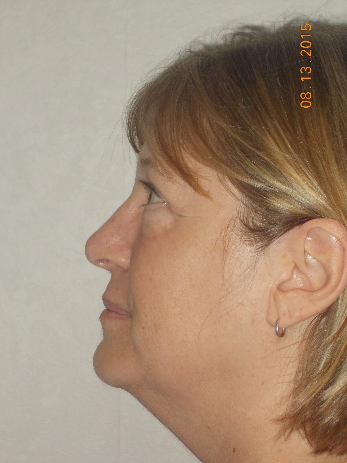 Side View After
