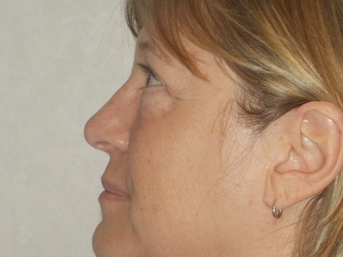 Side View After
