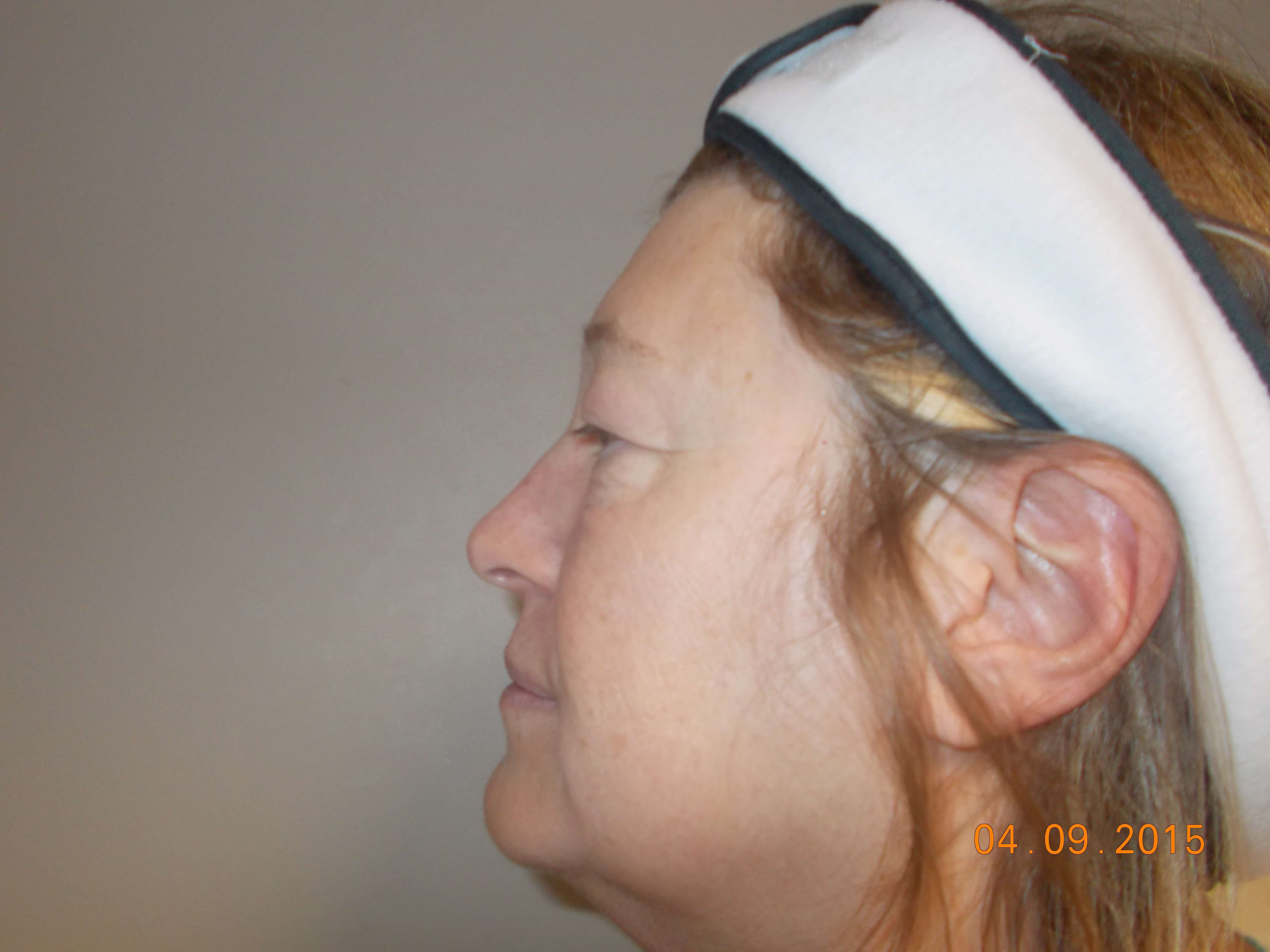 Side View Before
