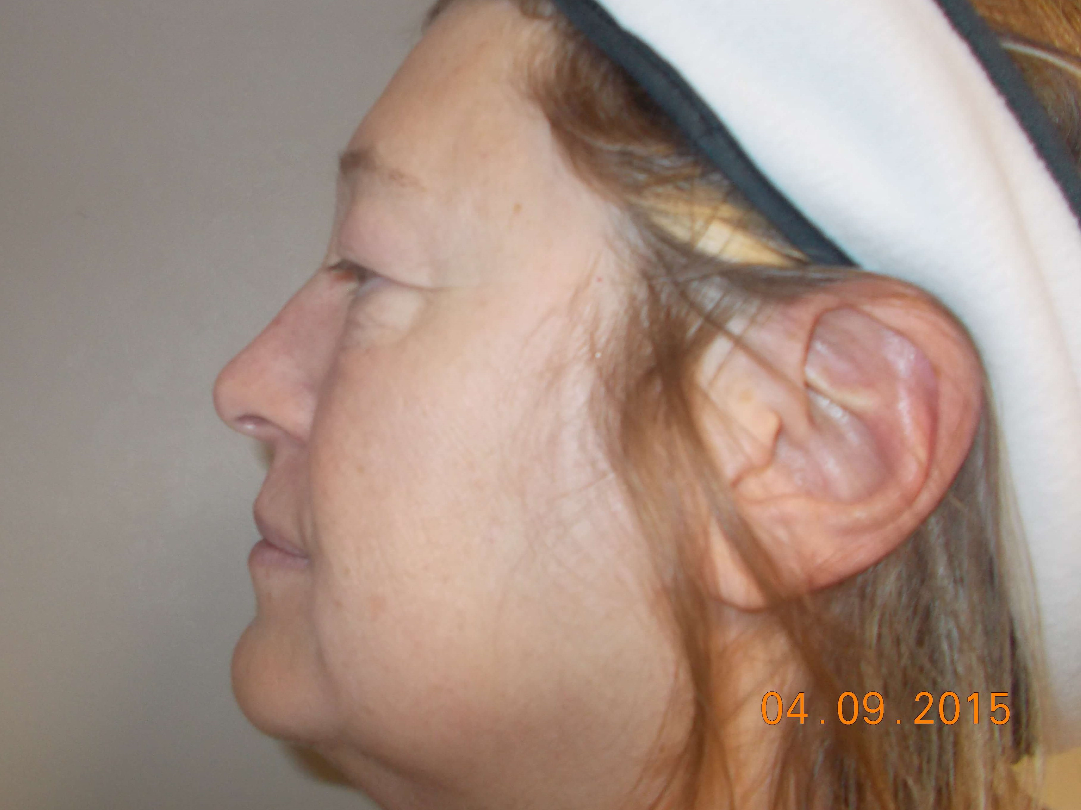 Side View Before