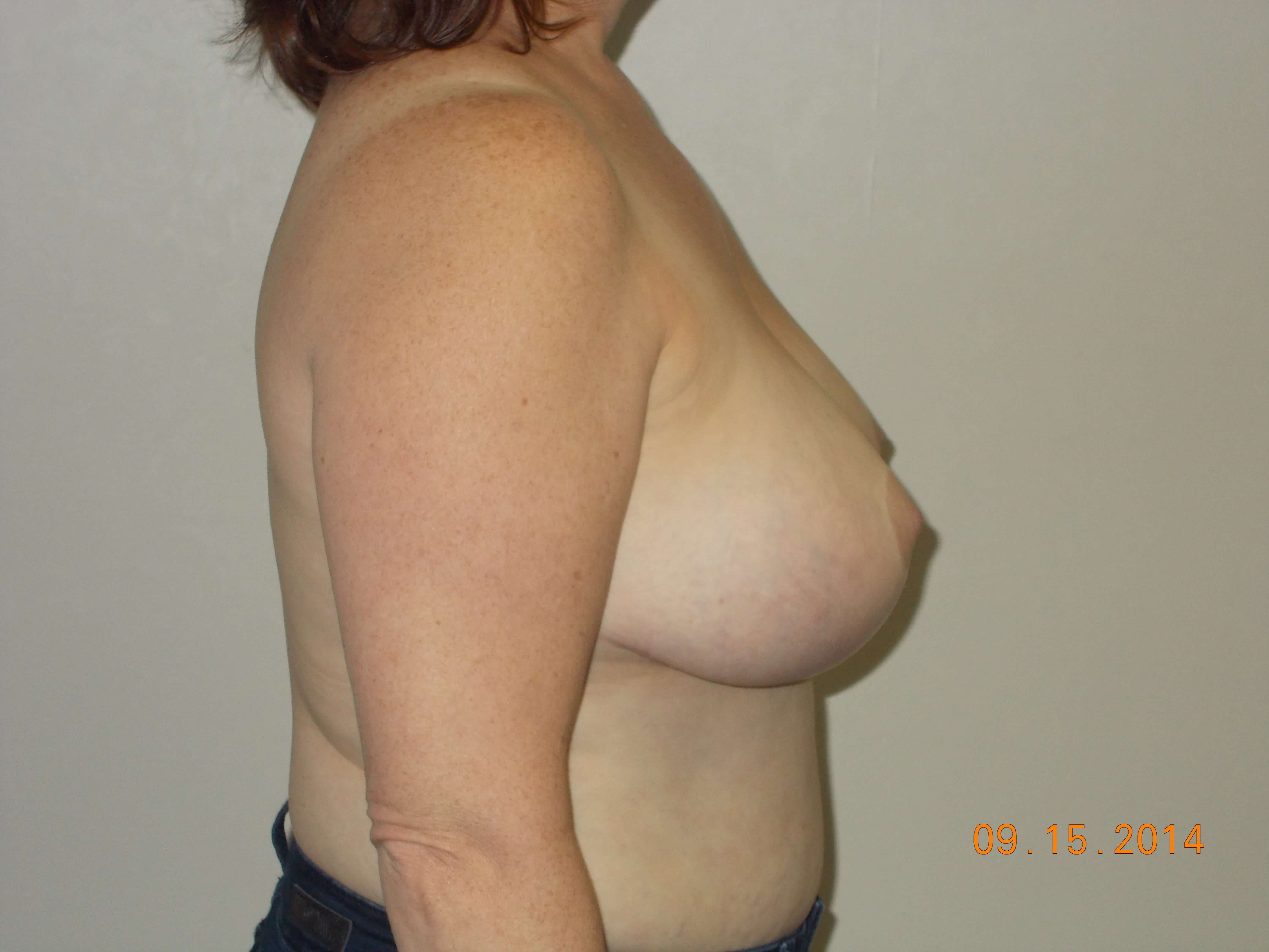 Side View Before