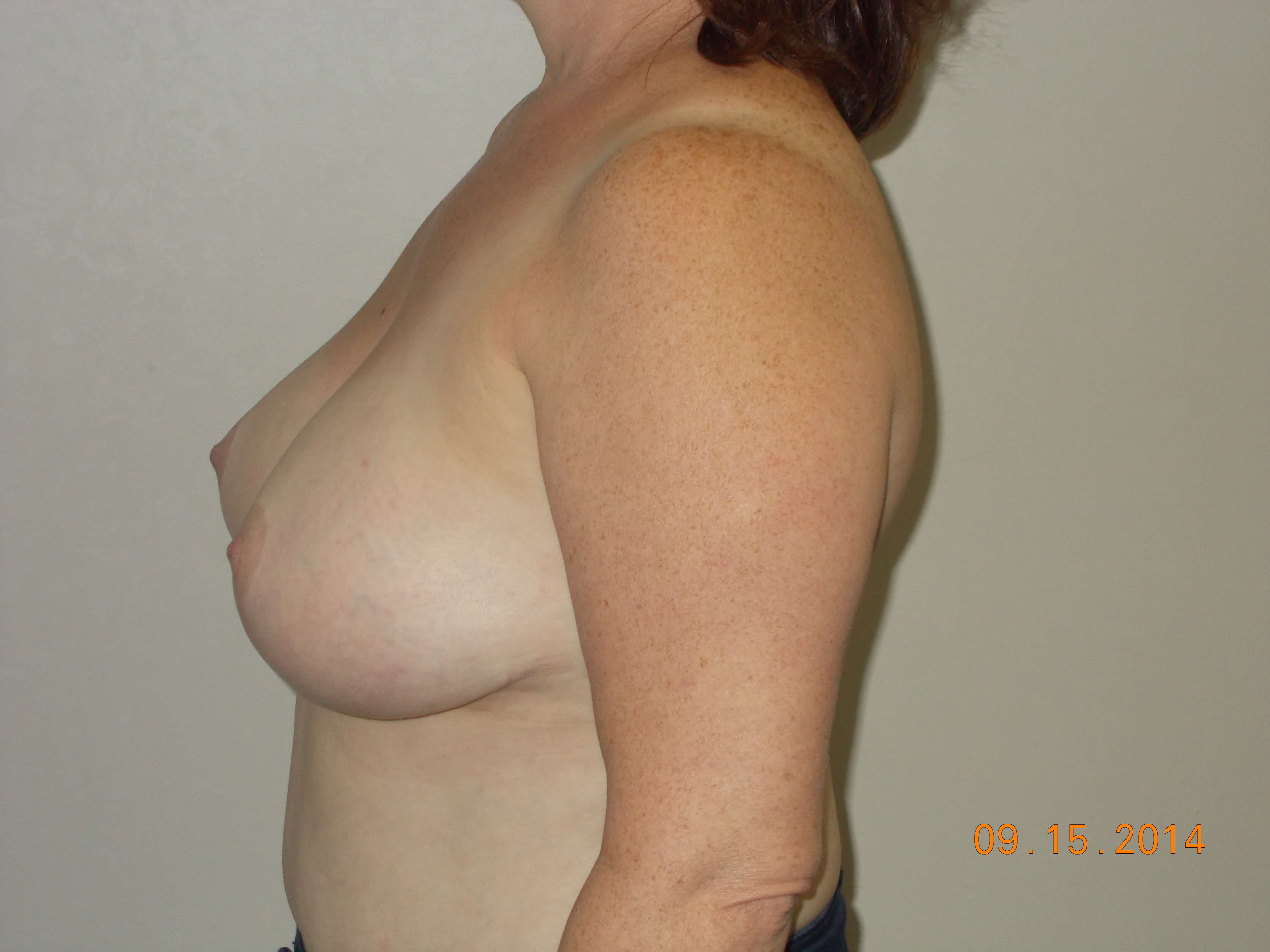 Side View Before