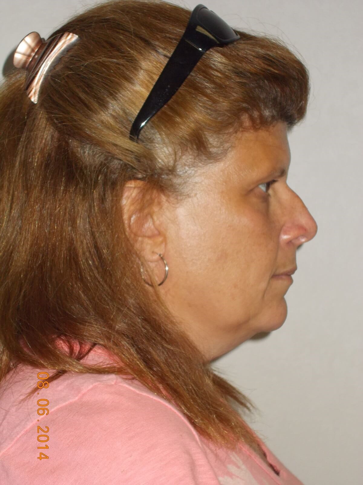 Side View Before