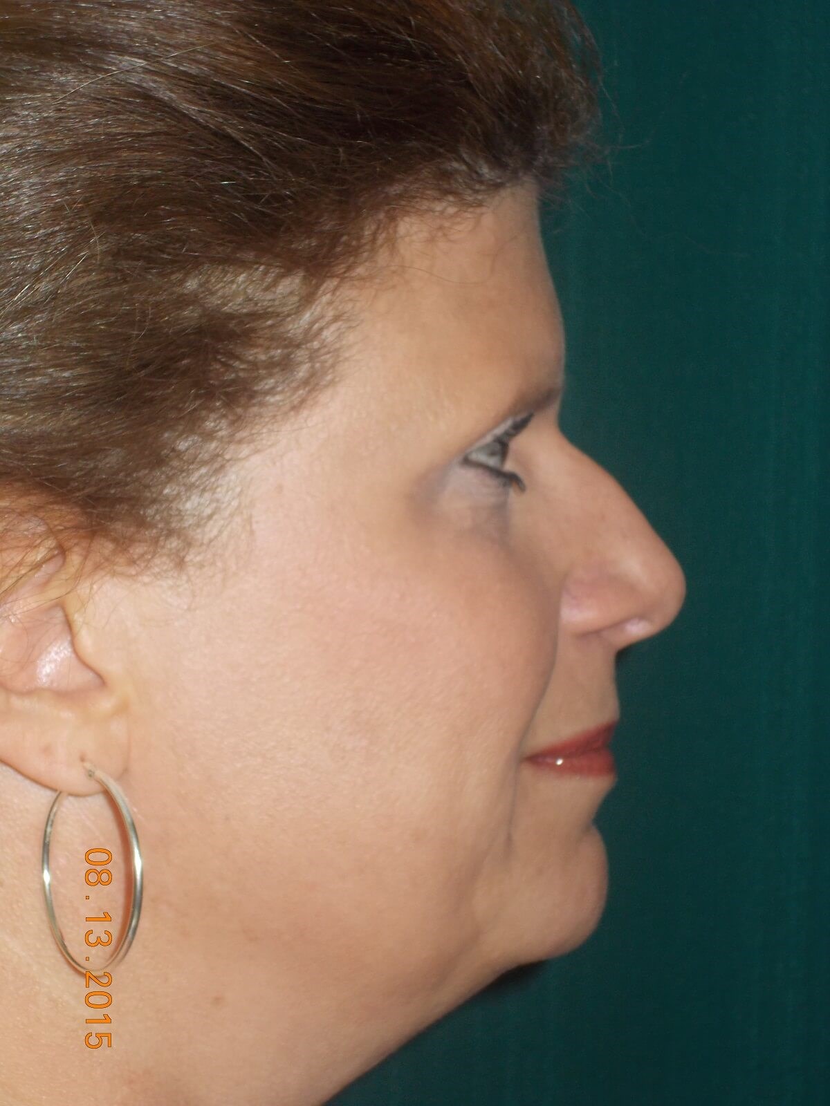 Side View After