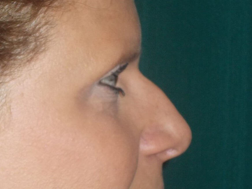 Side View After