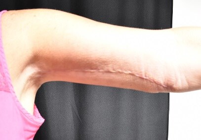 Front View of Left Arm After