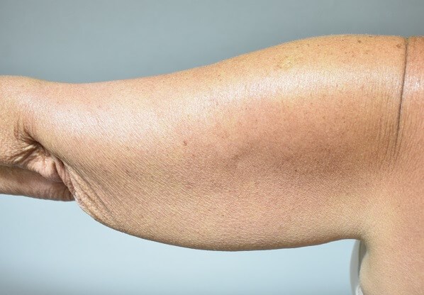 Back View of Right Arm Before