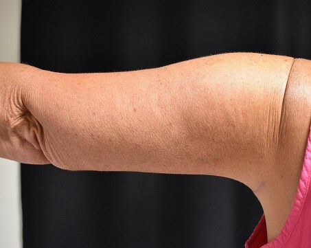 Back View of Right Arm After