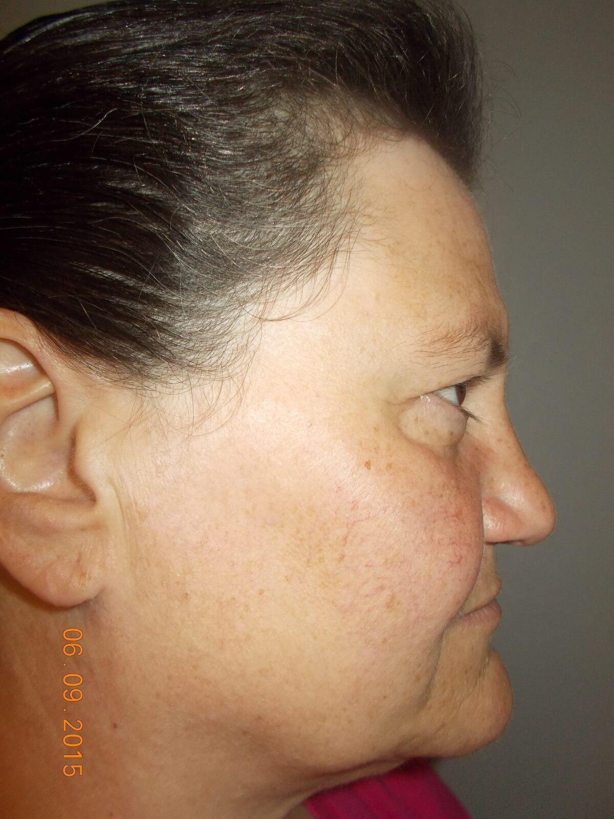 Side View Before