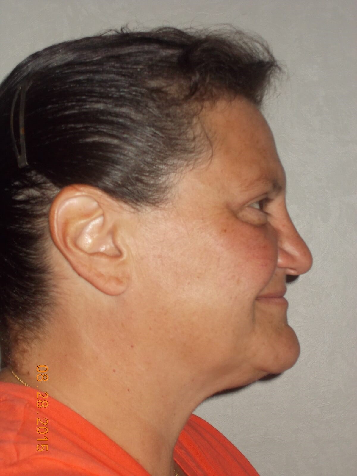 Side View After